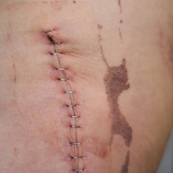 cicatriz con grapas, después del uso de una cadera artificial
 - Foto, imagen