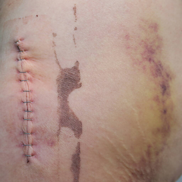 cicatrice avec agrafes, après l'utilisation d'une hanche artificielle - Photo, image