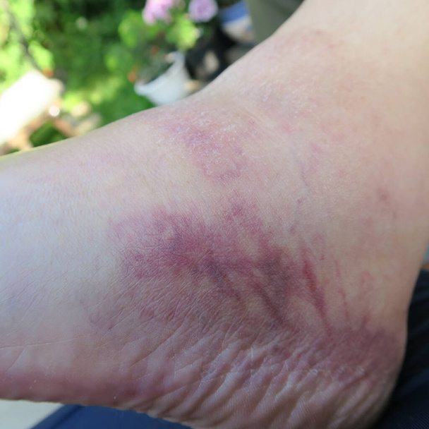 синие и красные опухшие ноги, болезнь
 - Фото, изображение