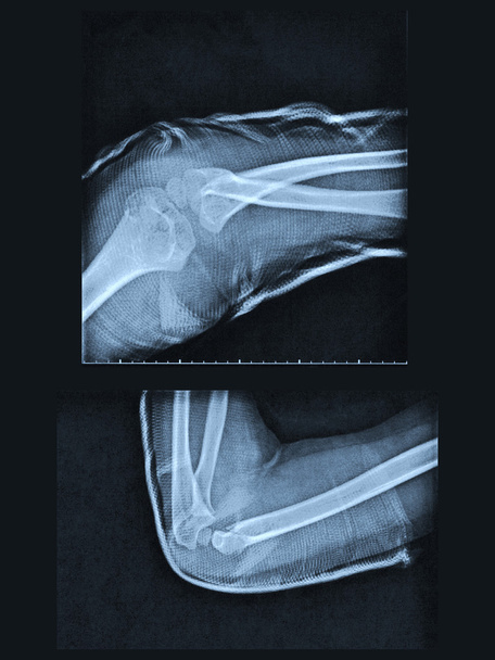 Radiografía de brazo roto
 - Foto, Imagen