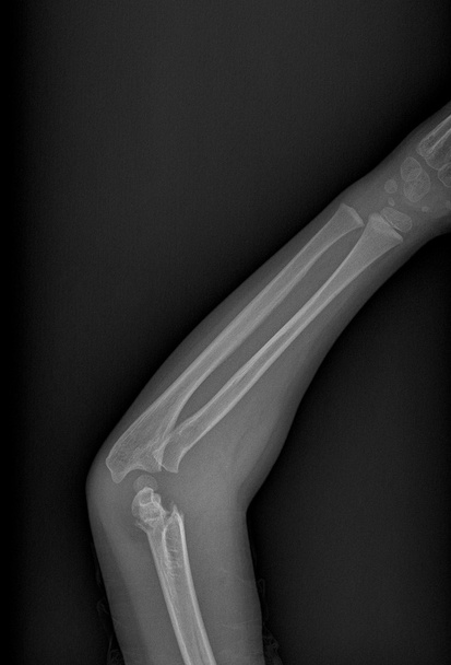 zlomená ruka xray - Fotografie, Obrázek