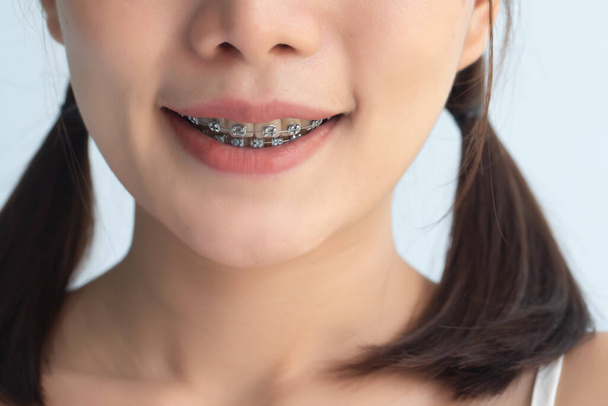 mujer feliz sonriendo con abrazaderas de dientes o ortodoncia abrazaderas dentales, concepto de cuidado dental cosmético
 - Foto, Imagen