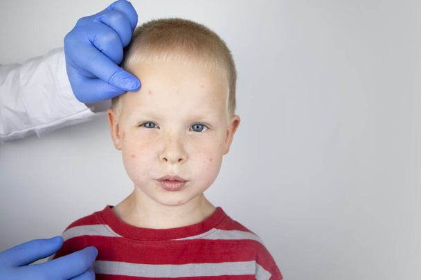 Алерг або дерматолог досліджує червоні плями на обличчі дитини. Хлопчик страждає від висипу, вуликів і свербіння. Алергія на харчі, укуси комах, свистки або віспа курчат - Фото, зображення