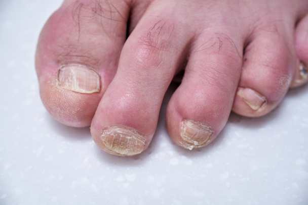 Clavos masculinos destruidos por onicolisis. Daño en las uñas de los pies masculinos. En el médico dermatólogo. Pedicura y tratamiento. Aislado en blanco Primer plano de las piernas
 - Foto, imagen