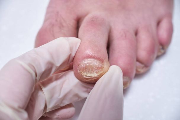 Podiatrist treating feet during procedure, examines the foot. Professional medical pedicure. Podiatry clinic Foot treatment. - Photo, Image