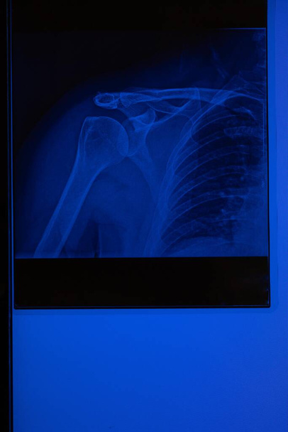 radiografia del medico della spalla destra - Foto, immagini