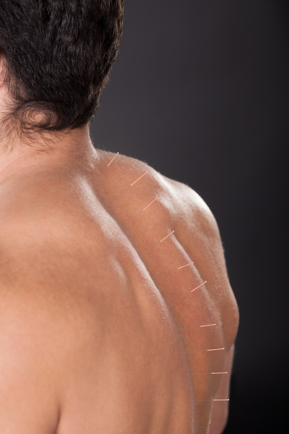 muž s akupunkturní jehly na zádech - Fotografie, Obrázek