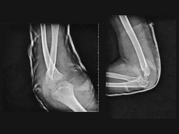 Röntgenbild gebrochener Arm - Foto, Bild