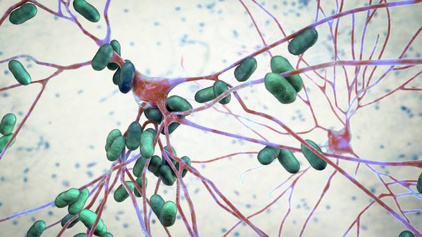 Bakterien infizieren Neuronen, Gehirnzellen, 3D-Illustration. Konzeptionelle Darstellung bakterieller Enzephalitis, Meningitis, bakterieller Infektion des Gehirngewebes - Foto, Bild