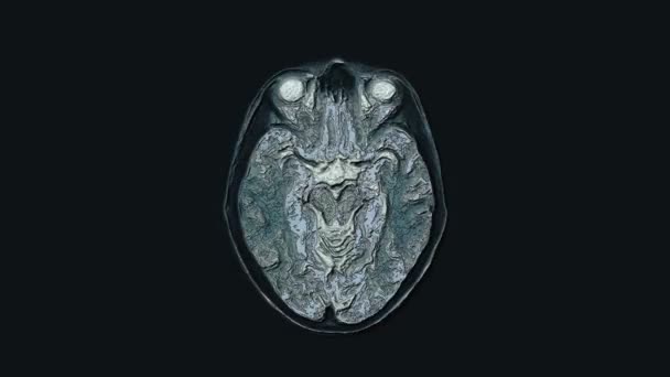 Çoklu renkli MRI beyni, kafa taraması ve tümör tespiti. Teşhis medikal aracı - Video, Çekim