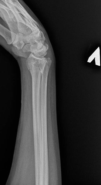 X-ray image of cracked human bone. Wrist fracture - Zdjęcie, obraz