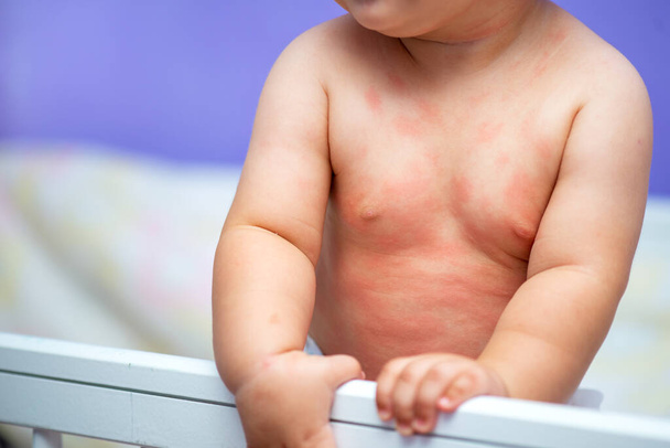 pequeño bebé con alergia en la cuna en casa
 - Foto, imagen