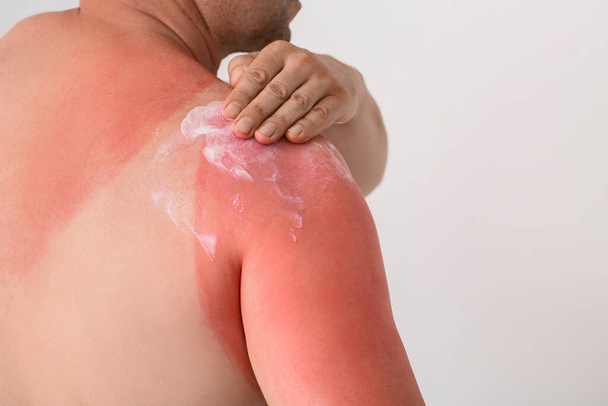 Man with red sunburned skin applying cream against light background, closeup - Fotografie, Obrázek