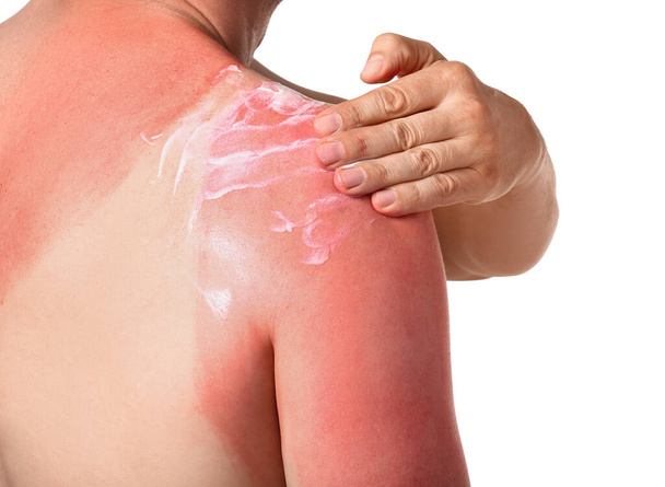 Man with red sunburned skin applying cream against white background, closeup - Foto, immagini