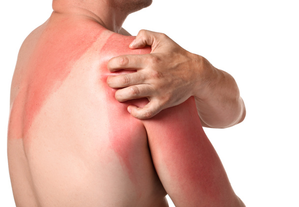 Man with red sunburned skin against white background - Foto, afbeelding