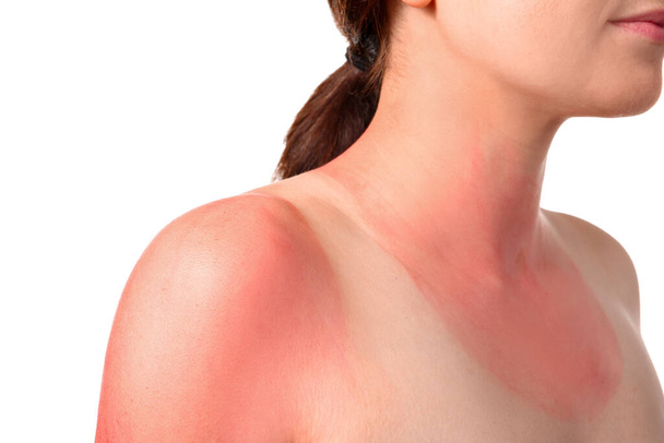 Woman with red sunburned skin against white background, closeup - Foto, Imagen