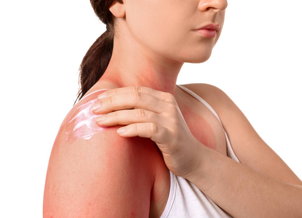 Woman with red sunburned skin applying cream against white background, closeup - Фото, изображение