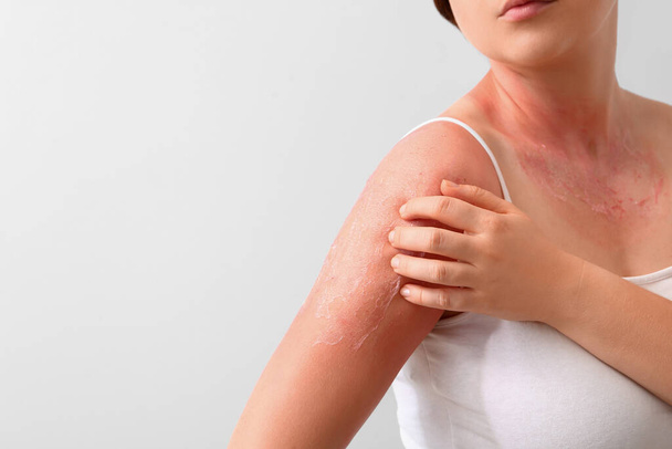 Woman with red sunburned skin against light background - Foto, Imagen