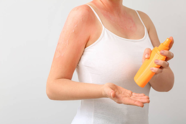 Donna con pelle bruciata dal sole rossa e crema protettiva contro lo sfondo bianco - Foto, immagini