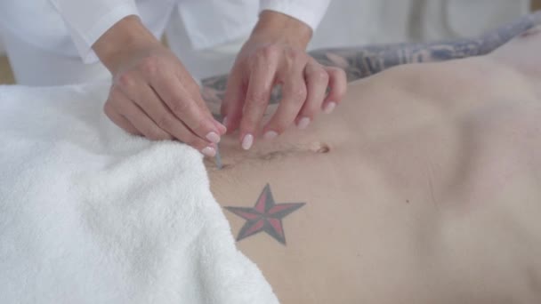 Unrecognizable female doctor inserting needles into male belly. Professional Caucasian acupuncturist healing stomachache with traditional chinese asian medicine. Acupuncture, alternative therapy. - Filmagem, Vídeo