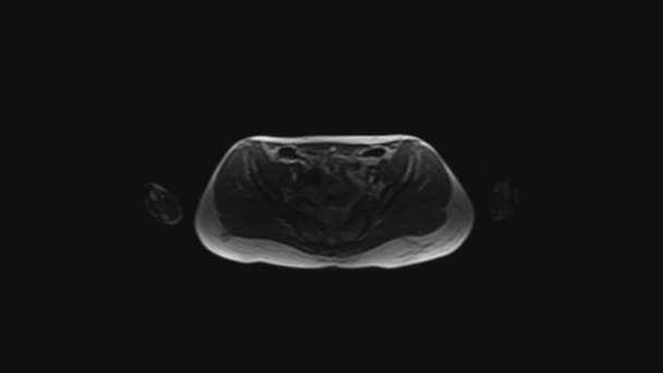 MRI of the female pelvic organs, abdominal cavity, gastrointestinal tract and bladder - Footage, Video