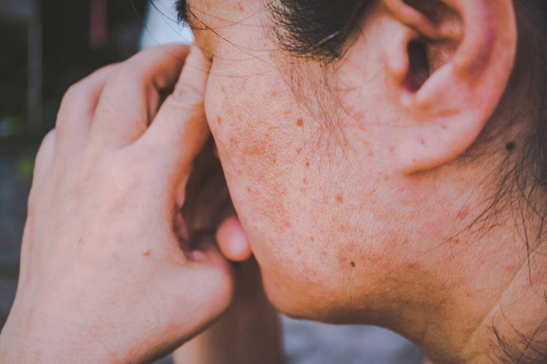 Vrouwen die problemen en stress problemen hebben., Vrouwen met huidproblemen en acne littekens - Foto, afbeelding
