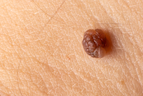 lunar marca de nacimiento nevus macro foto en la piel humana. De cerca.. - Foto, Imagen
