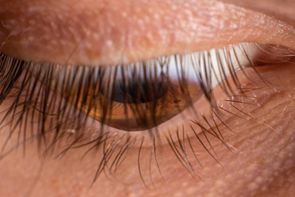Macro oogfoto. Keratoconus 3 graden - oogziekte, dunner worden van het hoornvlies in de vorm van een kegel. Het hoornvlies plastic - Foto, afbeelding