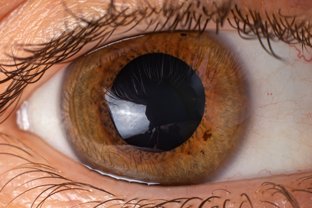 Keratoconus van het oog, 4e graad. Contortie van het hoornvlies in de vorm van een kegel, verslechtering van het gezichtsvermogen, astigmatisme. Macro close-up - Foto, afbeelding