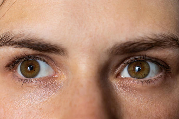 Keratokonus beider Augen 2. und 4. Grades. Kontorsion der Hornhaut in Form eines Kegels, Sehverschlechterung, Astigmatismus - Foto, Bild