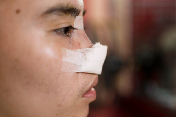 Seitenansicht einer Patientin frisch von einer Nasenkorrektur. Nase mit Verband bedeckt. - Foto, Bild