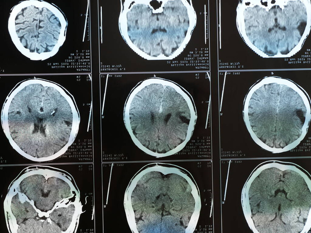 Μαγνητική τομογραφία εγκεφάλου μετά από τραύμα - Φωτογραφία, εικόνα