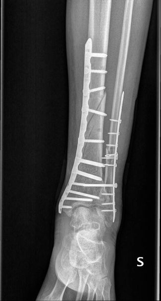 Рентген сломанной ноги с иглами
 - Фото, изображение