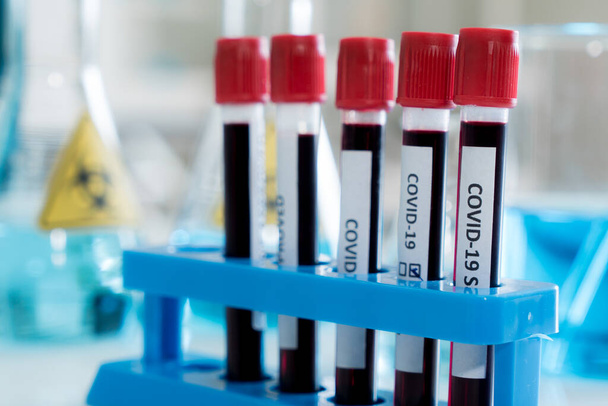 covid-19 análisis de sangre en tubo de vidrio en laboratorio médico
 - Foto, Imagen