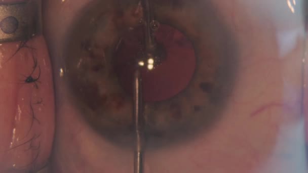 Macro filmagem de Eyes During Eye Surgery. Cirurgia oftalmológica. - Filmagem, Vídeo