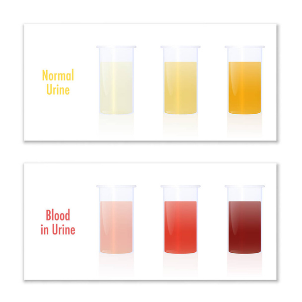 Blood in urine and normal urine in specimen cups, as comparison for laboratory examination and medical diagnosis of various urological diseases. Infographic vector illustration on white. - Vector, Image