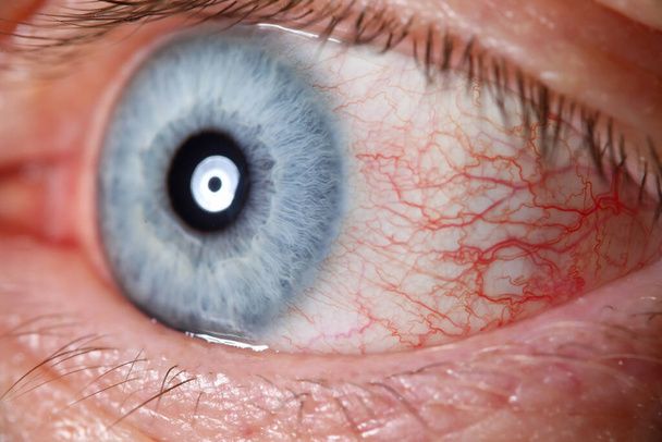Podrażniony mężczyzna niebieskie oko pełne z siatki kapilarnej - Zdjęcie, obraz