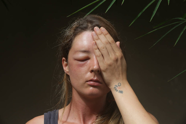 Young caucasian woman with a swollen eye from a wasp's sting. Allergy reaction on wasp bite. - Photo, Image