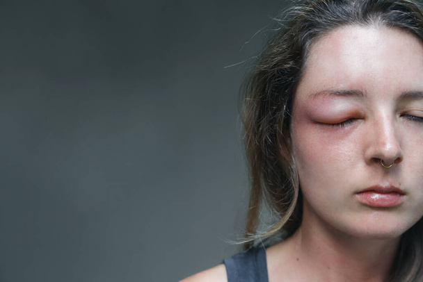 Mujer caucásica joven con un ojo hinchado de la picadura de una avispa. Reacción alérgica a la picadura de avispa
. - Foto, imagen