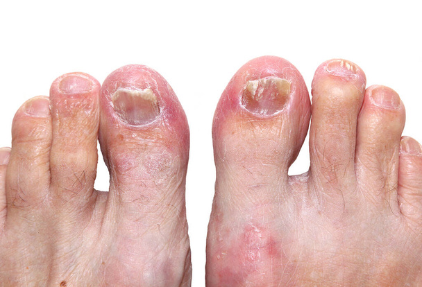 Umiarkowany do ciężkiego przypadek stóp sportowców (pedis zębów) wpływa na skórę stóp i palców. Również wykazujące grzyb paznokci. - Zdjęcie, obraz