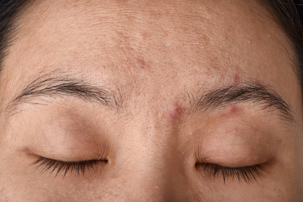 Gesichtshaut-Problem, Alterungsproblem bei Erwachsenen, Falten, Akne-Narben, große Poren und dunkle Flecken, trockene Haut. - Foto, Bild
