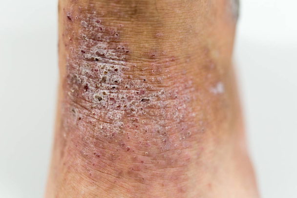 Um físico da dermatite atópica (DA), também conhecido como eczema atópico, é um tipo de inflamação da pele (dermatite
). - Foto, Imagem