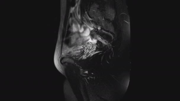 MRI żeńskich narządów miednicy, jamy brzusznej, przewodu pokarmowego i pęcherza moczowego - Materiał filmowy, wideo