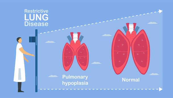 Pulmonale hypoplasie is onvolledig van longen. Het veroorzaakt lage grootte van alveoli. Pulmonologie over restrictieve longziekte. - Vector, afbeelding