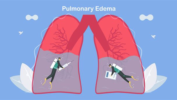 El edema pulmonar es un síntoma de que los pulmones se llenan de líquido. Tratamiento y diagnóstico. El cuerpo lucha para obtener suficiente oxígeno hasta la falta de aliento
. - Vector, Imagen