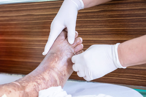 kädet pitelevät steriiliä neulaa ja puhkaisevat läpipainopakkauksen palohaavasta potilaan jalassa, toisen asteen palovammoja - Valokuva, kuva