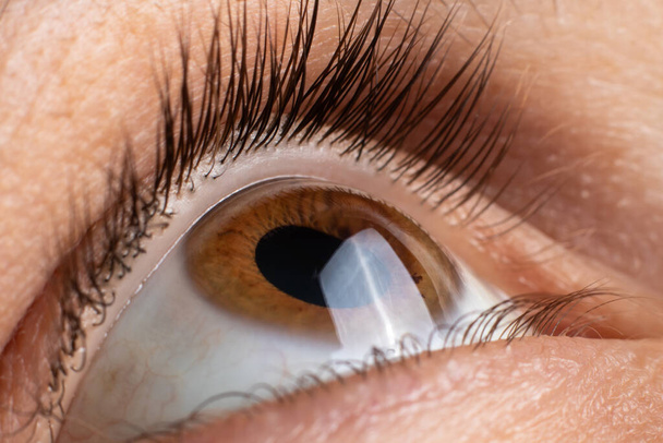 Keratoconus gözü, 4. derece. Korneanın koni şeklinde bükülmesi, görme bozukluğu, astigmatizm. Makro, kapat. - Fotoğraf, Görsel