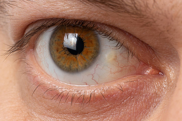 Pinguecula eyes Makroaufnahme des männlichen Auges. Gelbe Erziehung auf Eichhörnchen, Farmer Auge - Foto, Bild