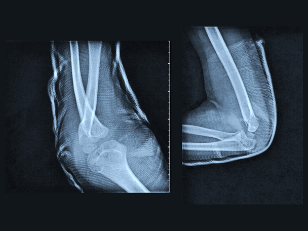 Murtunut käsivarren röntgenkuva
 - Valokuva, kuva
