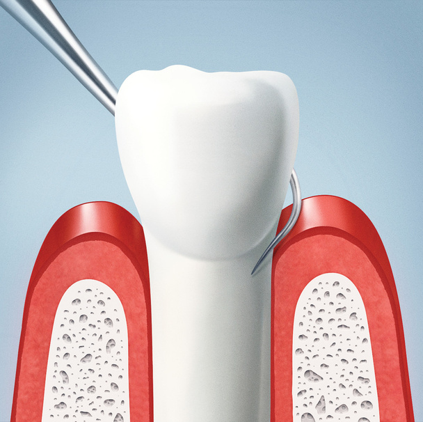 Zahn und Zahnfleisch - Foto, Bild